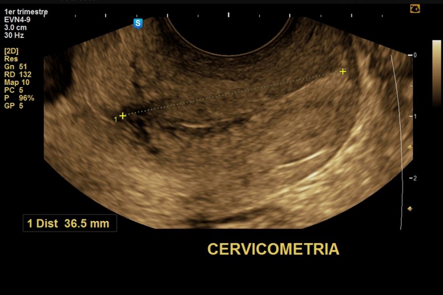 cervicometria