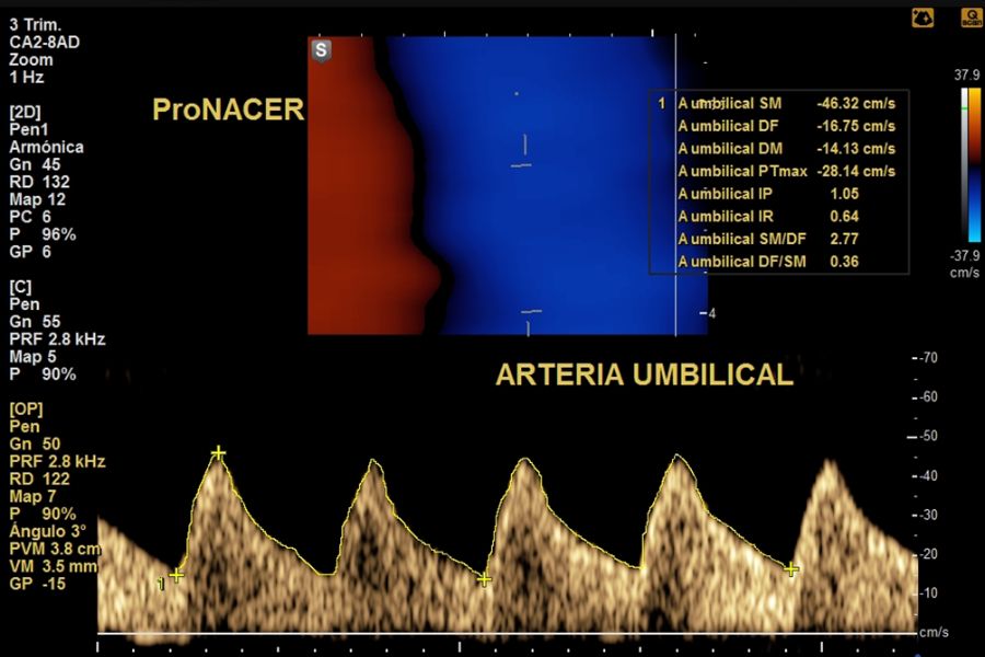 doppler fetoplacentario