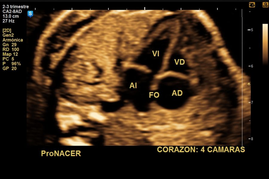 ecocardiografia fetal desde las 18 a 41 semanas