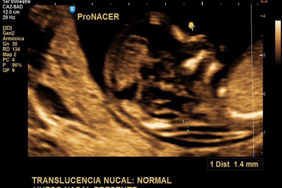 ecografia de tamizaje del i trimestre genetica desde las 11 a 14 semanas